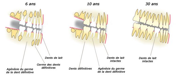 agenesie-dentaire